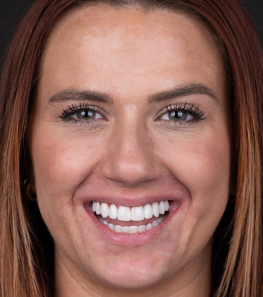 A Smile On Nashville patient smiling after her veneer treatment